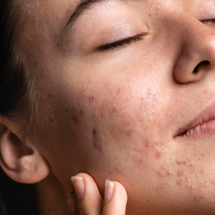 What is Fungal Acne?